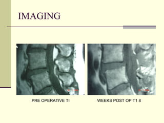 IMAGING




  PRE OPERATIVE TI   WEEKS POST OP T1 8
 