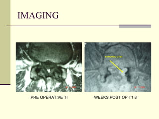 IMAGING



                         SYNOVIAL CYST




  PRE OPERATIVE TI   WEEKS POST OP T1 8
 