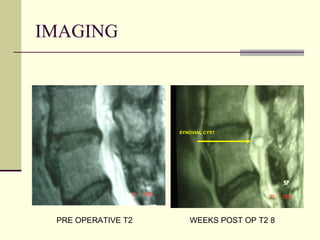 IMAGING




                    SYNOVIAL CYST




 PRE OPERATIVE T2      WEEKS POST OP T2 8
 