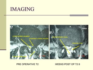 IMAGING



HYPERTOPHIED LIGAMENT
                                               DECOMPRESSED CANAL
                     STENOSED LATERAL RECESS


                                                                    SYNOVIAL CYST




HYPERTOPHIED JOINT




    PRE OPERATIVE T2                              WEEKS POST OP T2 8
 