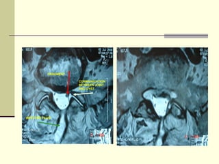 FRAGMENT

                       COMMUNICATION
                       BETWEEN JOINT
                       AND CYST




INFECTED FLUID
 