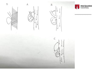 failed flow diverted aneurysm - Evidence Based Neurosurgery