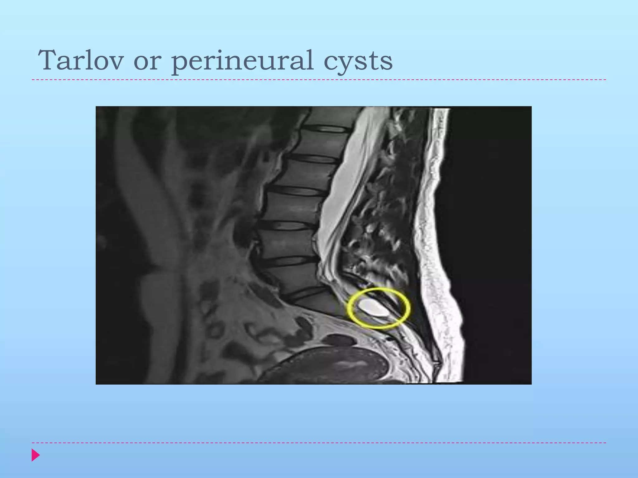 Failed spinal anaesthesia | PPTX