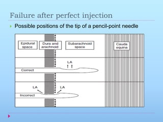 Injection Point Failure Failed spinal anaesthesia | PPTX