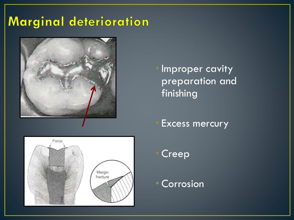 Failure of amalgam