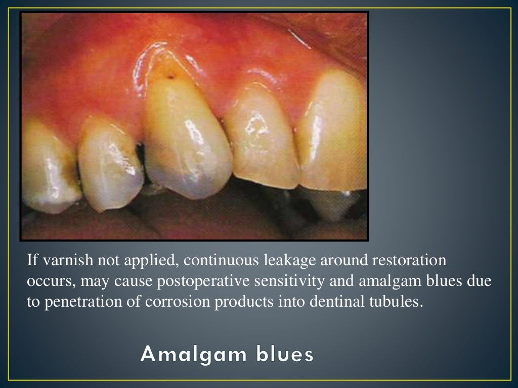 Failure of amalgam
