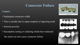 Connector Defects Examples FAILURES IN FIXED PARTIAL DENTURES | PPTX
