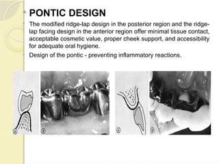 Failures in FPD and their management.pptx