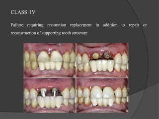 CLASS IV
Failure requiring restoration replacement in addition to repair or
reconstruction of supporting tooth structure
 