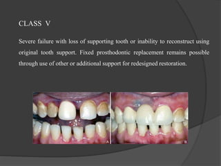CLASS V
Severe failure with loss of supporting tooth or inability to reconstruct using
original tooth support. Fixed prosthodontic replacement remains possible
through use of other or additional support for redesigned restoration.
 