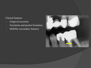 Clinical features
o Gingival recession
o Furcations and pocket formation
o Mobility (secondary feature).
 