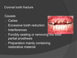 Coronal tooth fracture
Causes
o Caries
o Excessive tooth reduction
o Interferences
o Forcibly seating or removing the fixed
partial prosthesis
o Preparation mainly containing
restorative material
 