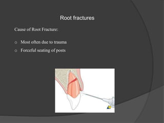 Root fractures
Cause of Root Fracture:
o Most often due to trauma
o Forceful seating of posts
 