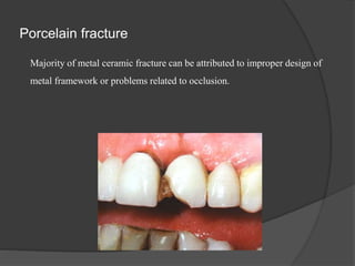 Porcelain fracture
Majority of metal ceramic fracture can be attributed to improper design of
metal framework or problems related to occlusion.
 