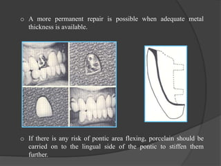 o A more permanent repair is possible when adequate metal
thickness is available.
o
o If there is any risk of pontic area flexing, porcelain should be
carried on to the lingual side of the pontic to stiffen them
further.
 