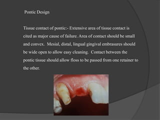 Pontic Design
Tissue contact of pontic:- Extensive area of tissue contact is
cited as major cause of failure. Area of contact should be small
and convex. Mesial, distal, lingual gingival embrasures should
be wide open to allow easy cleaning. Contact between the
pontic tissue should allow floss to be passed from one retainer to
the other.
 