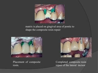 Placement of composite
resin.
Completed composite resin
repair of the lateral incisor
matrix is placed on gingival area of pontic to
shape the composite resin repair
 