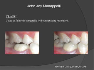 John Joy Manappallil
CLASS I
Cause of failure is correctable without replacing restoration.
J Prosthet Dent 2008;99:293-298
 