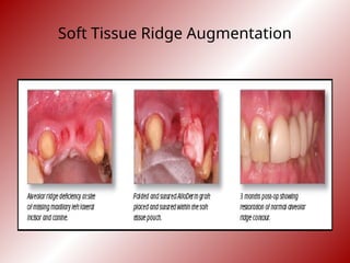 Tissue Ridges causes of failures in Periodontal therapy.ppt