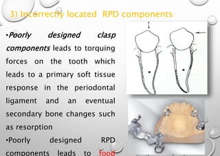 Failures in Removable Partial Denture Prosthodontics | PPTX