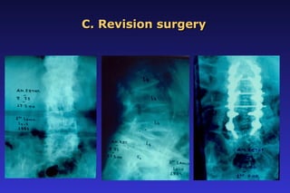 C. Revision surgeryC. Revision surgery
 