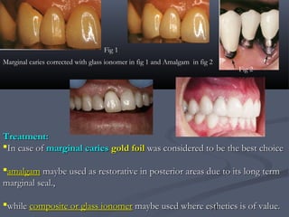 14
Marginal caries corrected with glass ionomer in fig 1 and Amalgam in fig 2
Fig 2
Fig 1
Treatment:Treatment:
In case ofIn case of marginal cariesmarginal caries gold foilgold foil was considered to be the best choicewas considered to be the best choice
amalgamamalgam maybe used as restorative in posterior areas due to its long termmaybe used as restorative in posterior areas due to its long term
marginal seal.,marginal seal.,
whilewhile composite or glass ionomercomposite or glass ionomer maybe used where esthetics is of value.maybe used where esthetics is of value.
 