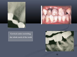 16
Cervical caries encircling
the whole neck of the tooth
 