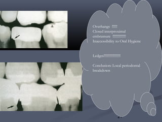 21
Overhangs !!!!!!
Closed interproximal
embrassure !!!!!!!!!!!!!!!
Inaccessibility to Oral Hygiene
Ledges!!!!!!!!!!!!!!!!!!!
Conclusion: Local periodontal
breakdown
 