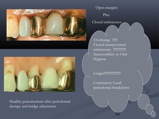 22
Healthy periodontium after periodontal
therapy and bridge adjustment
Open margins
Plus
Closed embrasures
Overhangs !!!!!!
Closed interproximal
embrassure !!!!!!!!!!!!!!!
Inaccessibility to Oral
Hygiene
Ledges!!!!!!!!!!!!!!!!!!!
Conclusion: Local
periodontal breakdown
 
