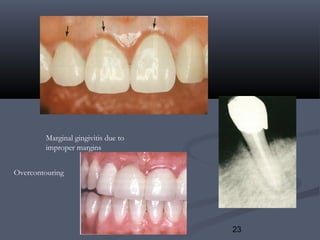23
Marginal gingivitis due to
improper margins
Overcontouring
 