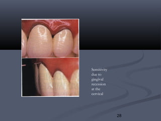 28
Sensitivity
due to
gingival
recession
at the
cervical
 