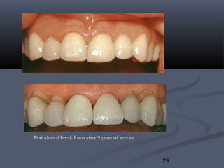 29
Periodontal breakdown after 9 years of service
 