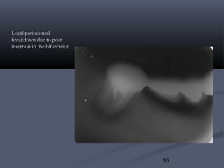 30
Local periodontal
breakdown due to post
insertion in the bifurcation
 