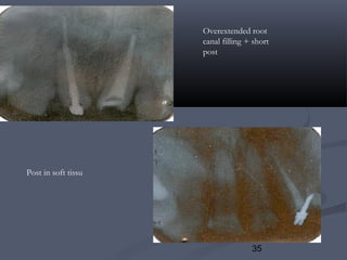 35
Overextended root
canal filling + short
post
Post in soft tissu
 