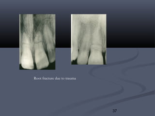 37
Root fracture due to trauma
 