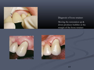 41
Diagnosis of loose retainer:
Moving the restoration up &
down produces bubbles at the
margin of the loose retainer
 