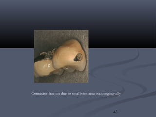 43
Connector fracture due to small joint area occlusogingivally
 