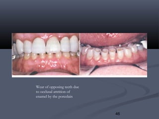 46
Wear of opposing teeth due
to occlusal attrition of
enamel by the porcelain
 
