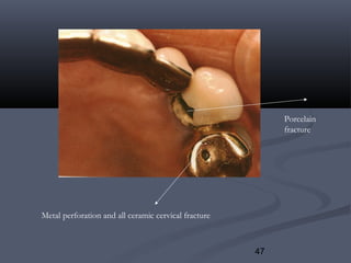 47
Metal perforation and all ceramic cervical fracture
Porcelain
fracture
 