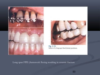 50
Long span FPD ,framework flexing resulting in ceramic fracture
 