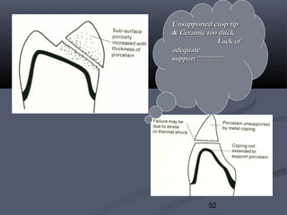 52
Unsupported cusp tipUnsupported cusp tip
& Ceramic too thick& Ceramic too thick
Lack ofLack of
adequateadequate
supportsupport !!!!!!!!!!!!!!!!!!!!!!!!!!!!!!!!!!
 