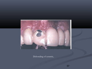 57
Debonding of ceramic,
 