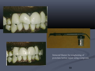 59
Intraoral blaster for roughening of
porcelain before repair using composite
 