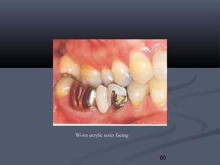 60
Worn acrylic resin facing
 