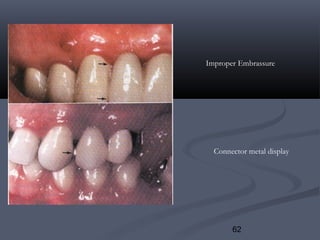 62
Improper Embrassure
Connector metal display
 
