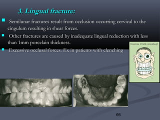 66
3. Lingual fracture:3. Lingual fracture:
 Semilunar fractures result from occlusion occurring cervical to theSemilunar fractures result from occlusion occurring cervical to the
cingulum resulting in shear forces.cingulum resulting in shear forces.
 Other fractures are caused by inadequate lingual reduction with lessOther fractures are caused by inadequate lingual reduction with less
than 1mm porcelain thickness.than 1mm porcelain thickness.
 Excessive occlusal forces. Ex in patients with clenchingExcessive occlusal forces. Ex in patients with clenching
 