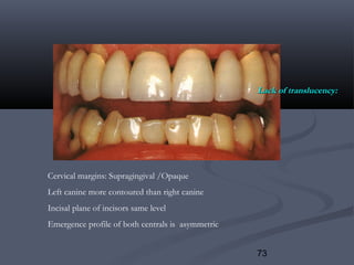 73
Cervical margins: Supragingival /Opaque
Left canine more contoured than right canine
Incisal plane of incisors same level
Emergence profile of both centrals is asymmetric
Lack of translucency:Lack of translucency:
 