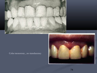 74
Color monotony , no translucency
 