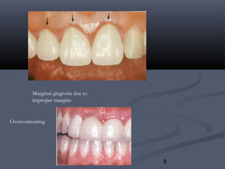 8
Marginal gingivitis due to
improper margins
Overcontouring
 