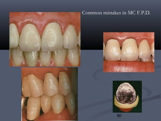 80
Common mistakes in MC F.P.D.
 